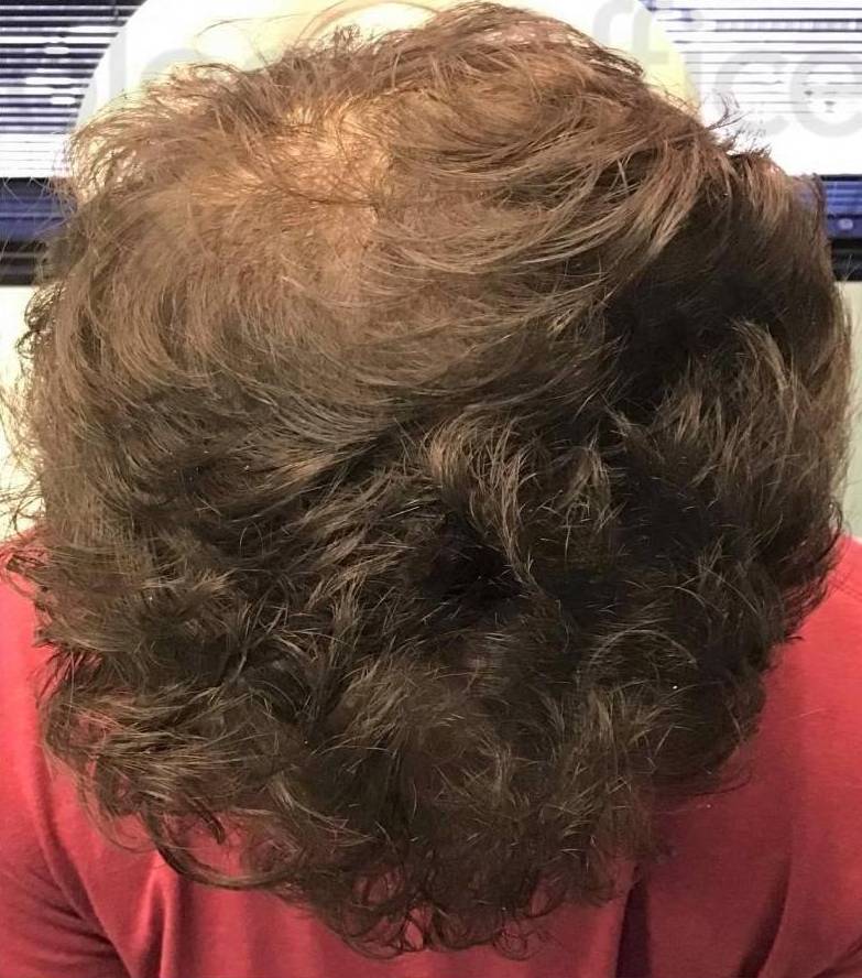 Exoflo Hair Restoration (2 Syringes) Case 9 After