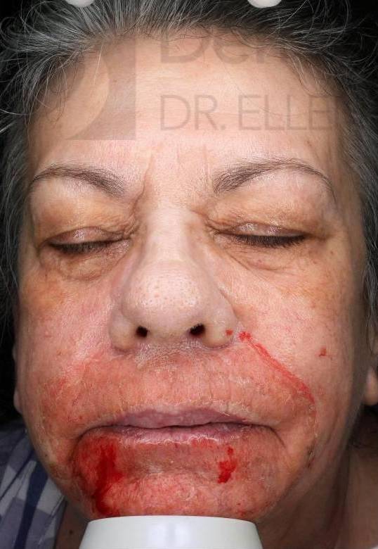 Laser Resurfacing (1 Treatment) Case-1 Before