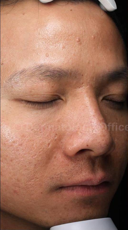 HALO™ Before and After Case 11 Before