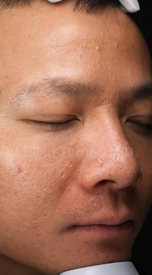 HALO™ Before and After Case 11 After