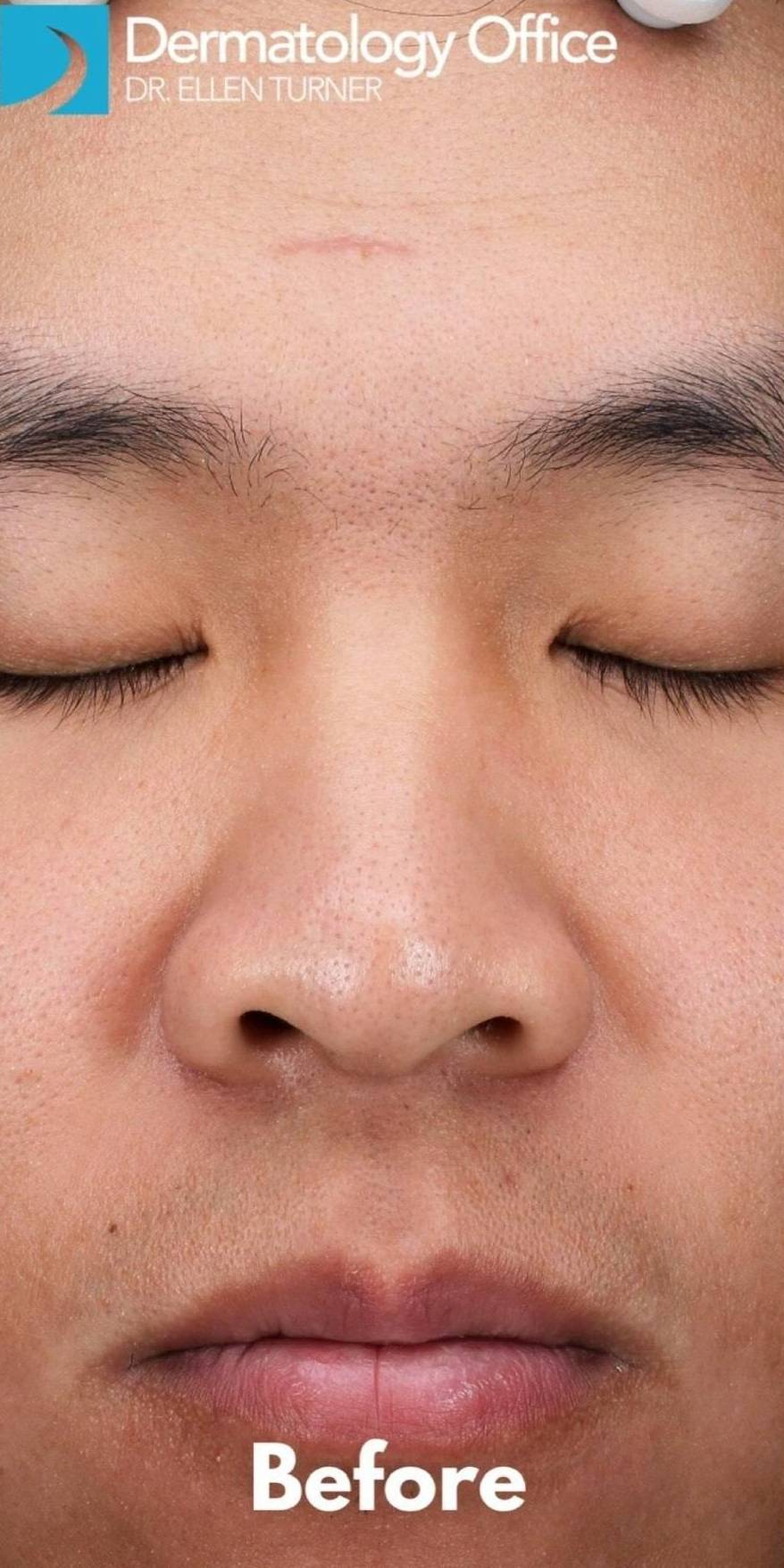 HALO™ Before and After Case 6 Before