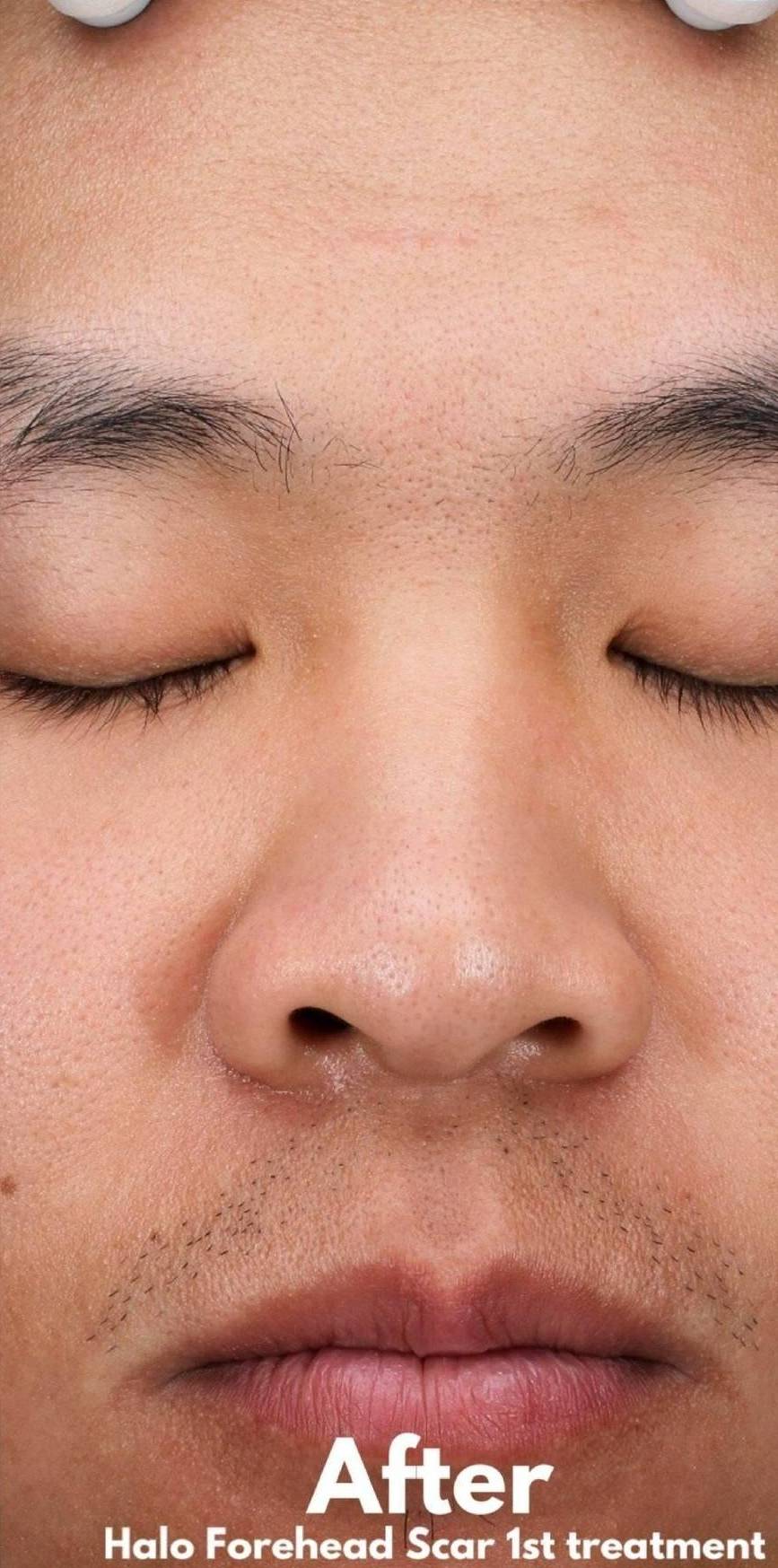 HALO™ Before and After Case 6 After