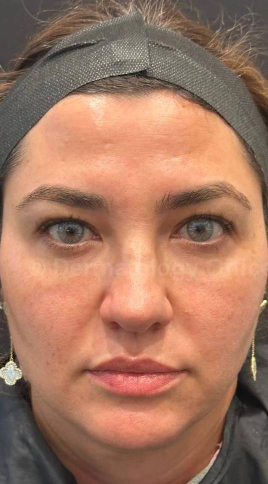 HALO™ Before and After Case 10 Before