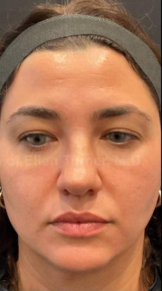 HALO™ Before and After Case 10 After