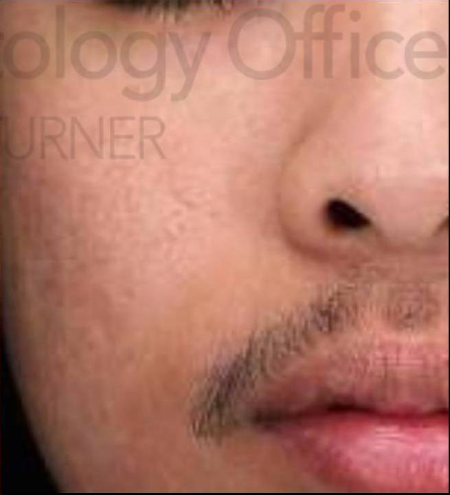 HALO™ (2 Treatment) Case 1 After