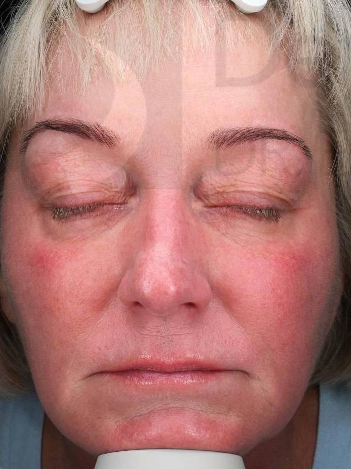 IPL-Photofacial/BBL BroadBand Laser Case-11 Before