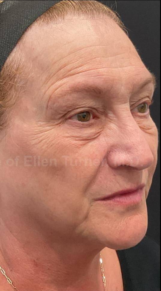 IPL-Photofacial/BBL BroadBand Laser Case-12 After