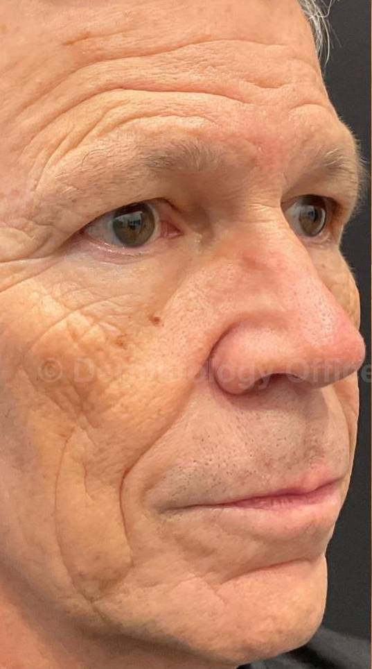 IPL-Photofacial/BBL BroadBand Laser Case-13 Before