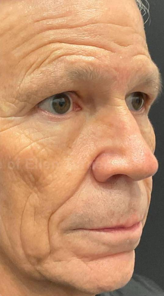 IPL-Photofacial/BBL BroadBand Laser Case-13 After