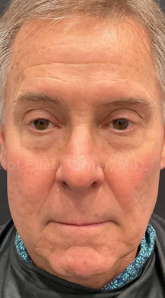 Picocare 450 Before and After Case-9 After