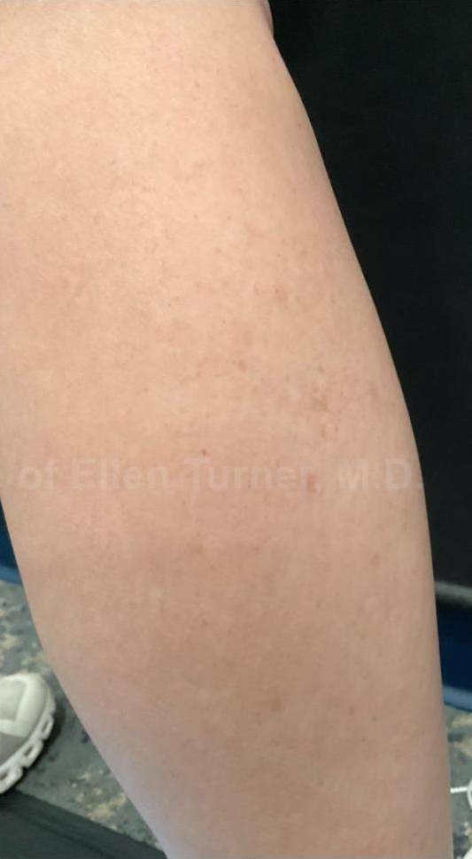 Picocare 450 Before and After Case-8 After