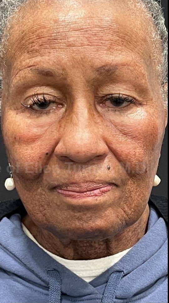 Picocare 450 Before and After Case-6 After