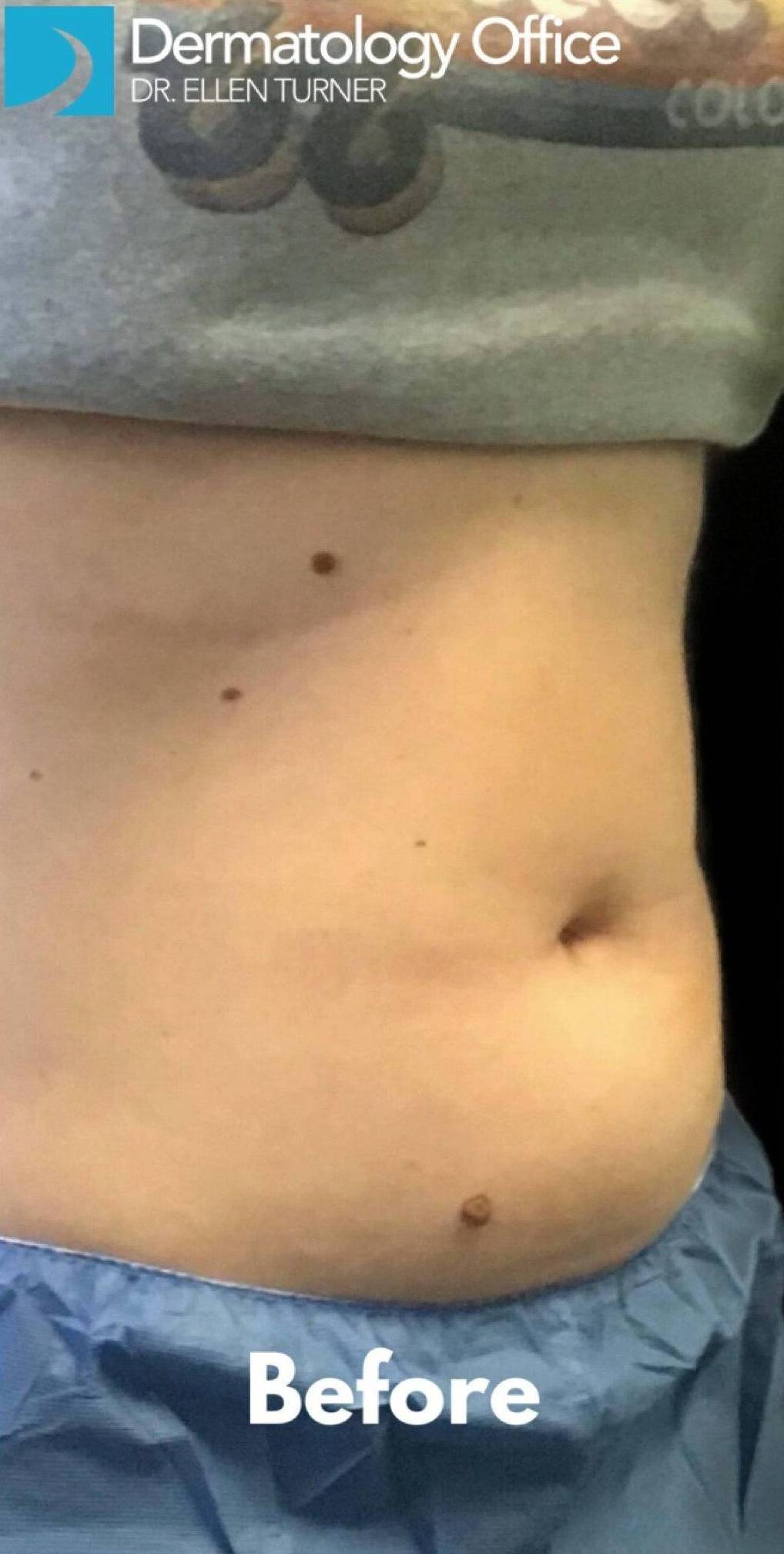 CoolSculpting<sup>&reg;</sup> Before and After Case 14 Before
