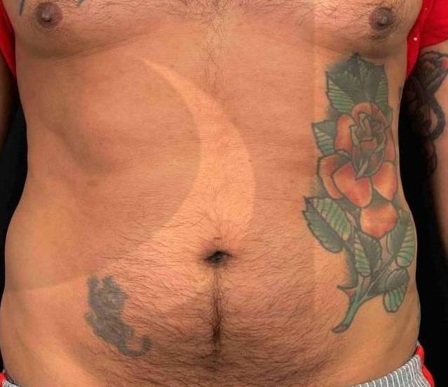 CoolSculpting Elite (3 Treatments) Case 1 Before