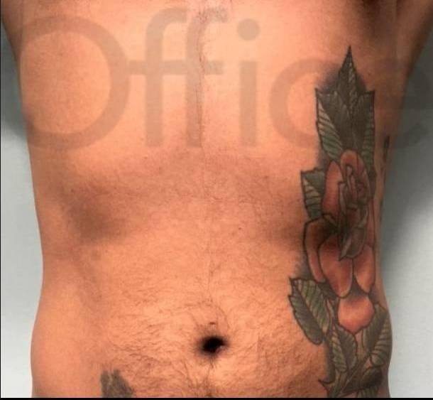 CoolSculpting Elite (3 Treatments) Case 1 After