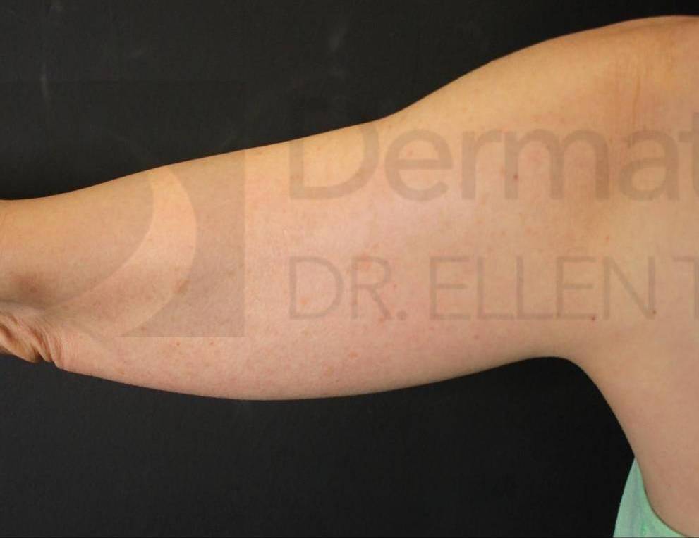 CoolSculpting Elite (2 Treatments) Case-2 Before