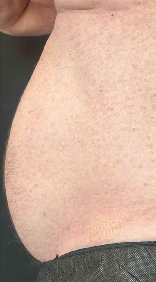 EMSculpt Neo (6 Treatments) Case-6 Before