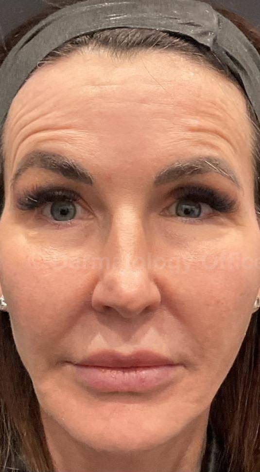 EMFACE Before and After-61 Before