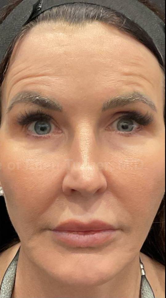 EMFACE Before and After-61 After