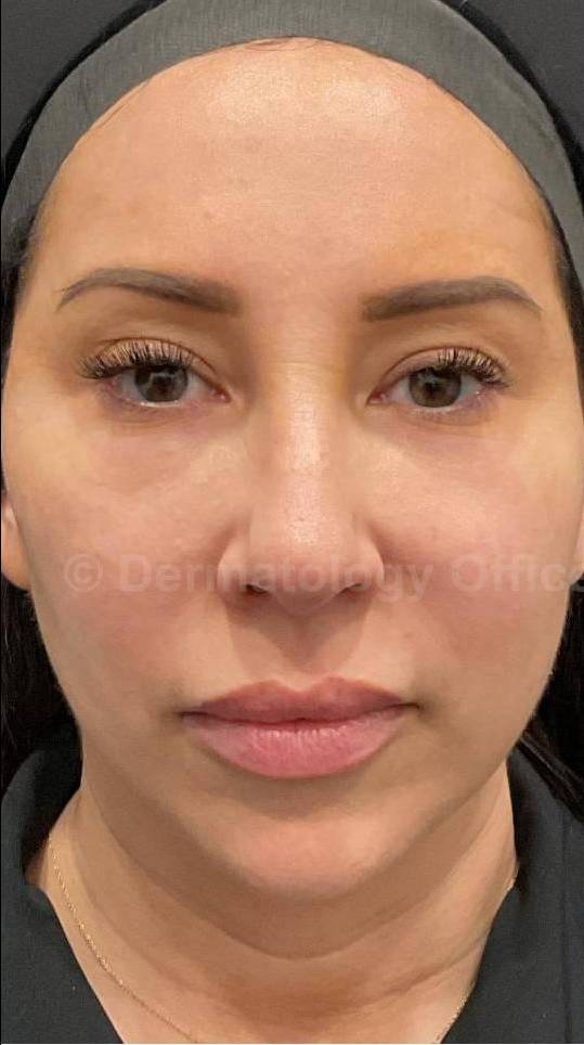 EMFACE Before and After-62 Before