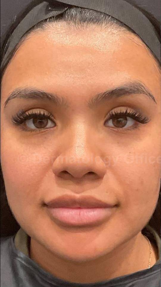 EMFACE Before and After-63 Before