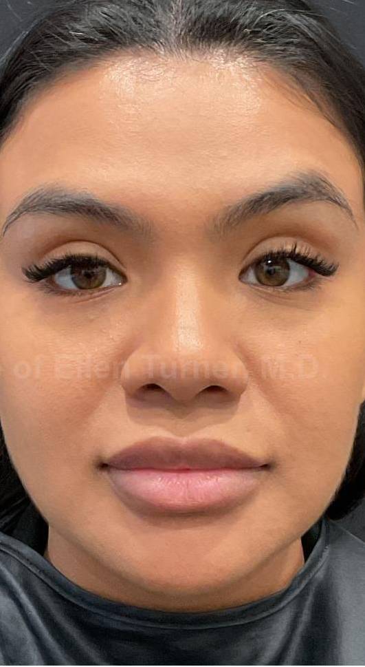 EMFACE Before and After-63 After