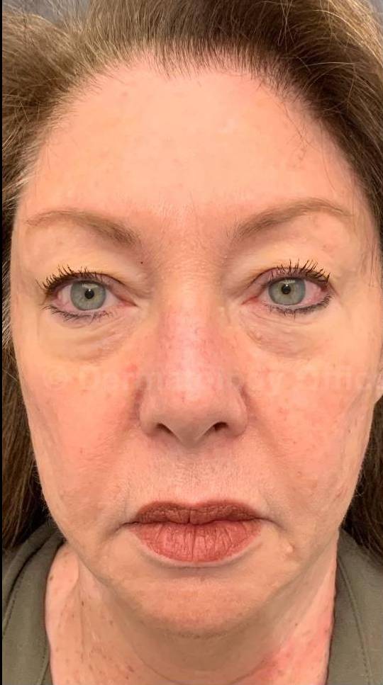 EMFACE Before and After-64 Before