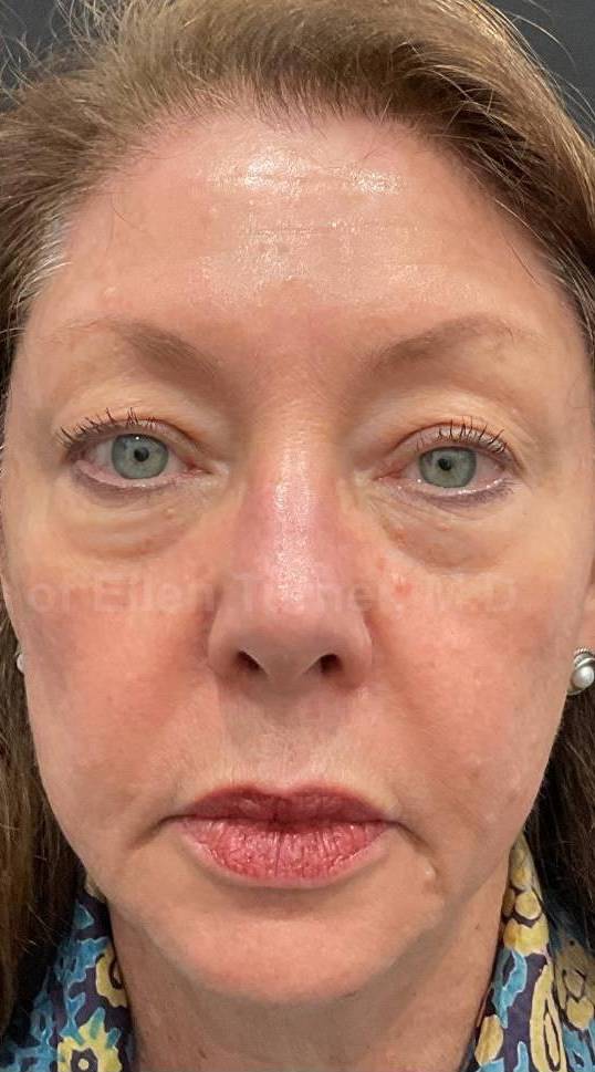 EMFACE Before and After-64 After