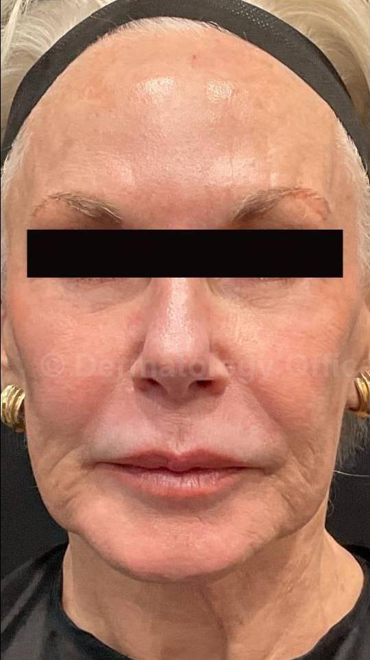 Exion HA Before and After Case 1 Before