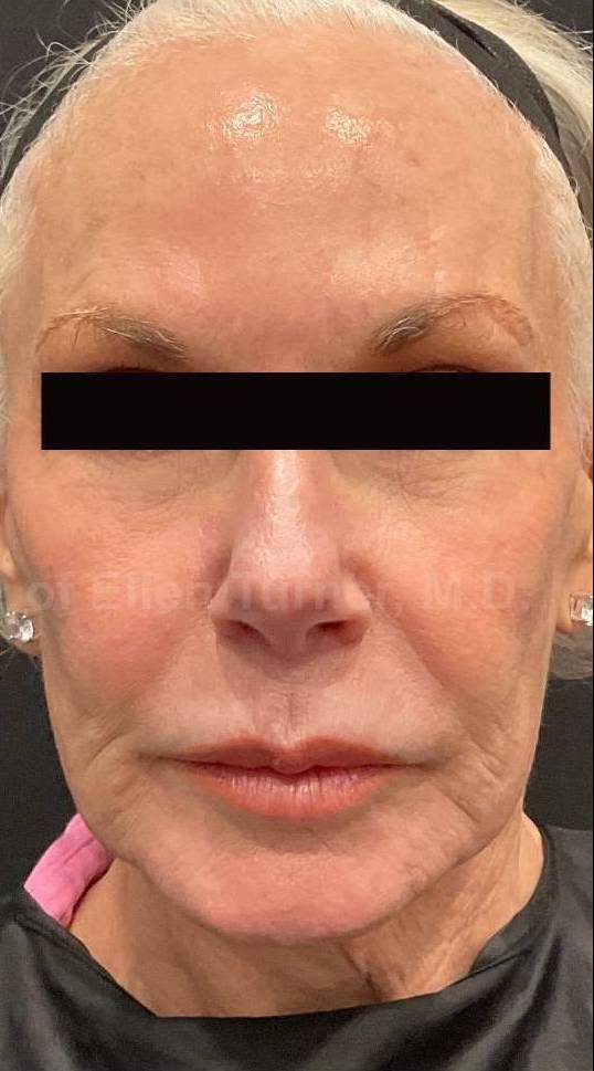 Exion HA Before and After Case 1 After