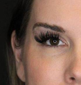 Sculptra (1 vials) Case 3 Before