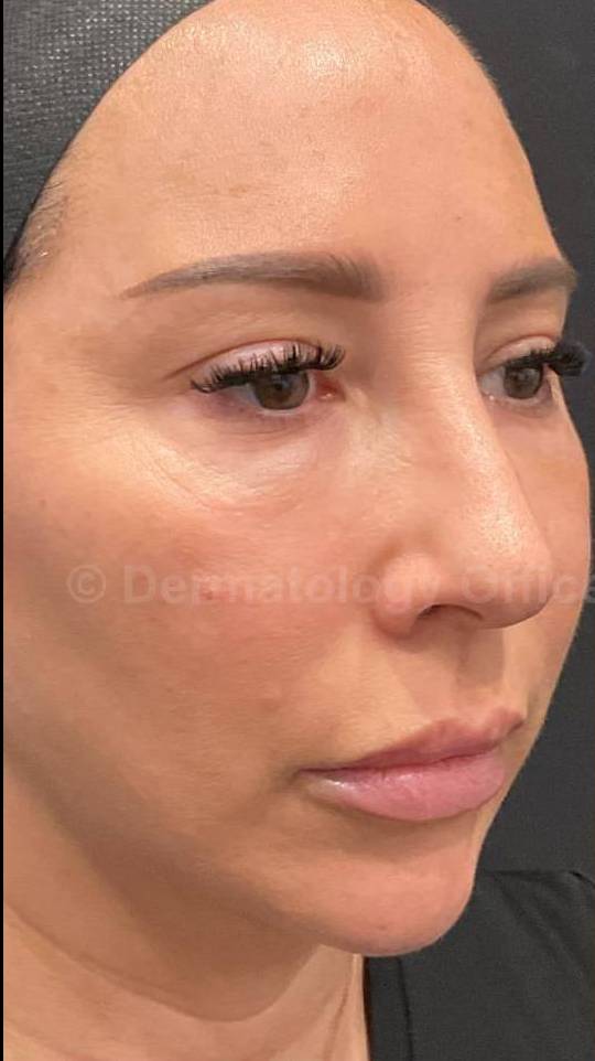 Silhouette Instalift Before and After Case-15 Before