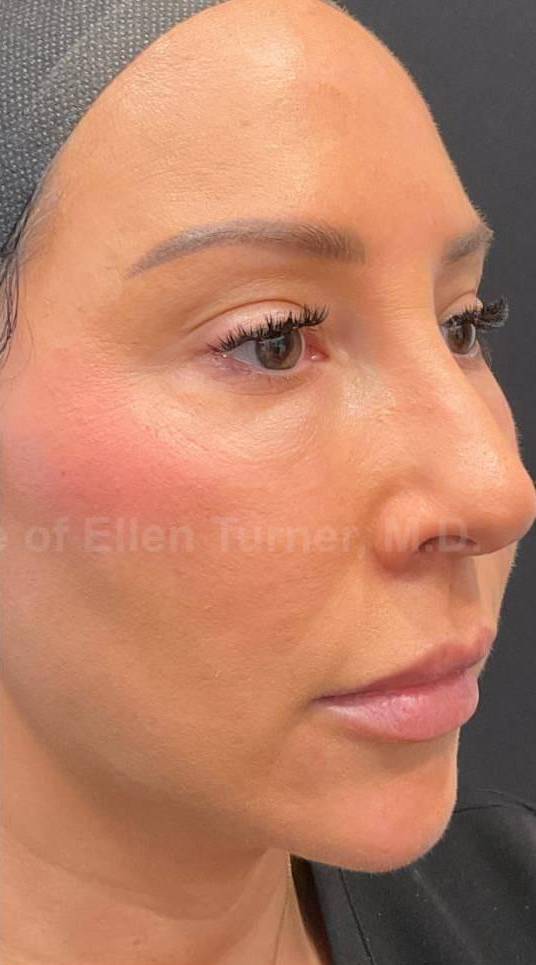 Silhouette Instalift Before and After Case-15 After