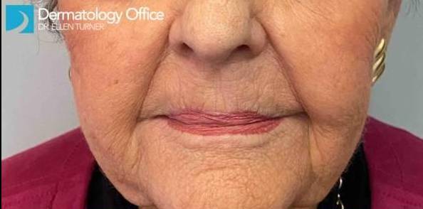 Silhouette InstaLift Before and After Case 4 Before