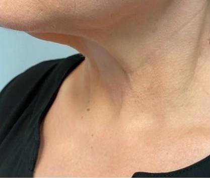 Silhouette Instalift Before and After Case 10 Before