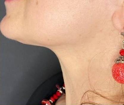 Silhouette Instalift Before and After Case 10 After