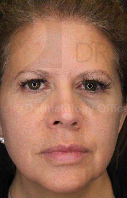 Silhouette InstaLift (8 Strings) Case-13 Before