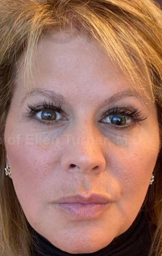 Silhouette InstaLift (8 Strings) Case-13 After