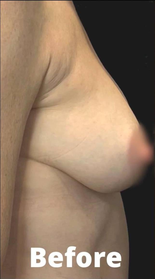 Silhouette InstaLift Before and After Case-14 Before