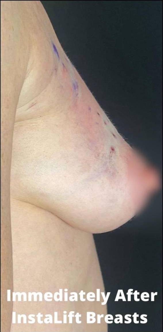 Silhouette InstaLift Before and After Case-14 After