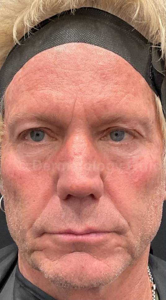 Ultherapy Before and After Case 10 Before