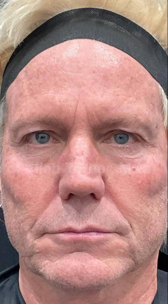 Ultherapy Before and After Case 10 After