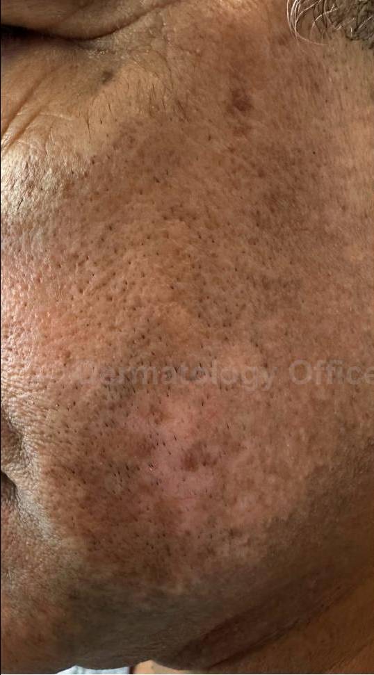 Before and After Vitiligo Case 5 Before