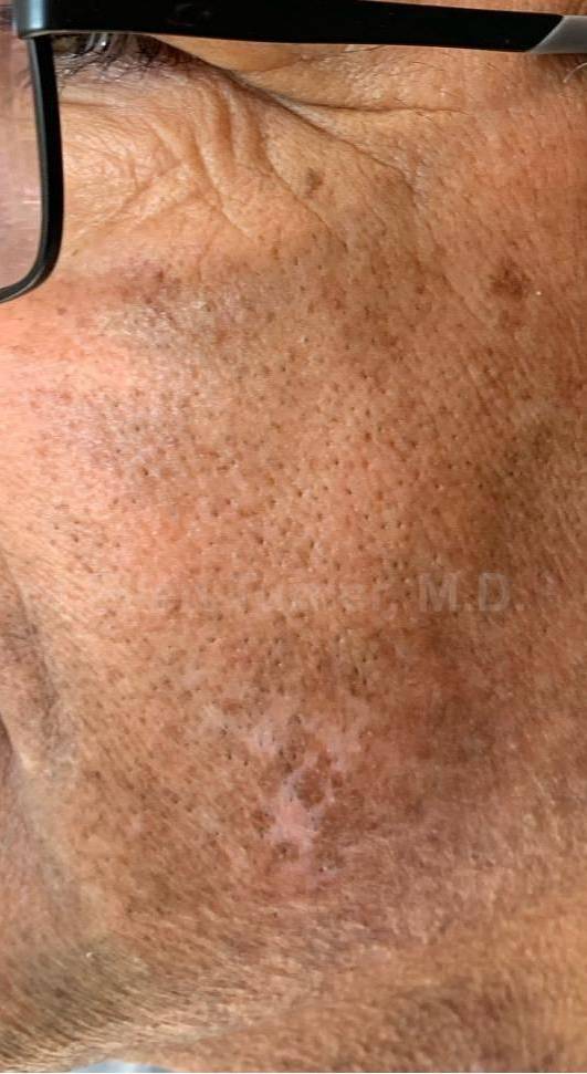 Before and After Vitiligo Case 5 After