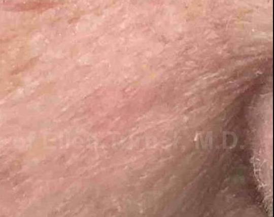 SRT-100 Before and After Case 2 After