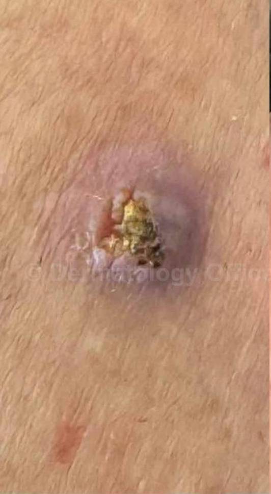 SRT-100 Before and After Case 3 Before