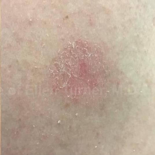 SRT-100 Before and After Case 6 After