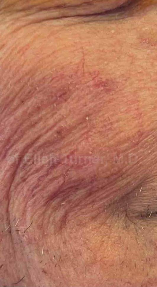 SRT-100 Before and After Case 7 After