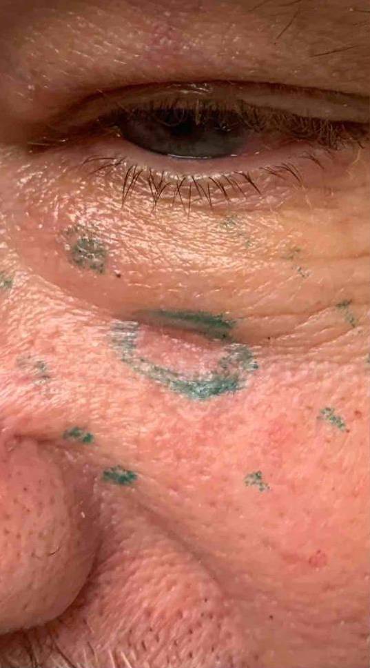 SRT-100 Before and After Case 8 Before