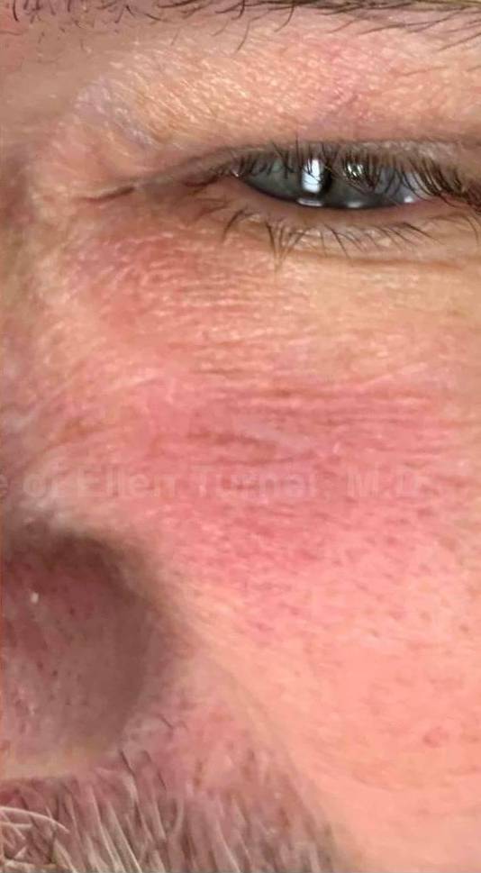 SRT-100 Before and After Case 8 After